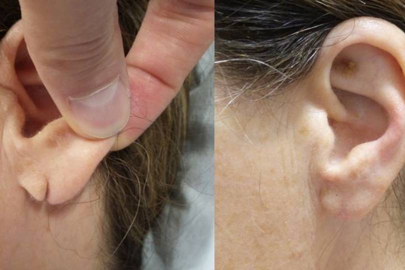 Ear Lobe repair in Baner