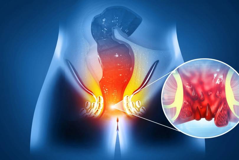 Fistula Treatment in baner