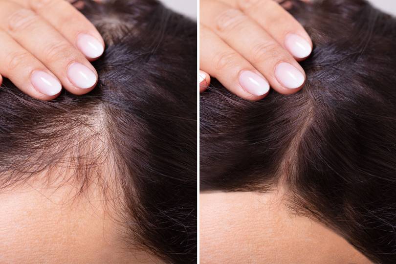 Hair loss treatment in Baner