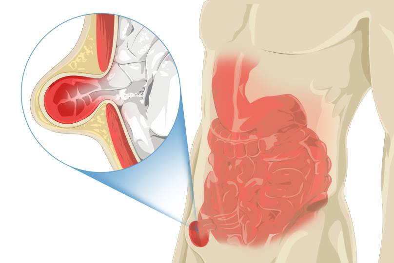 Hernia Treatment in Baner
