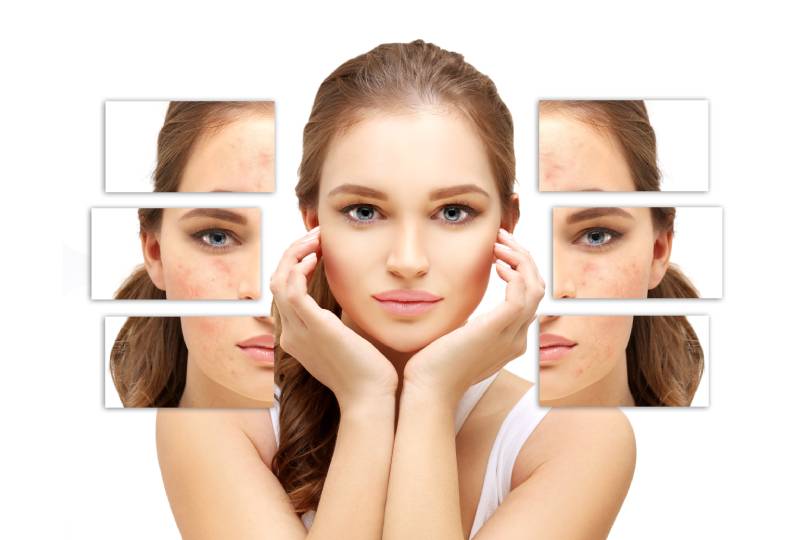 acne and scar treatment in Baner