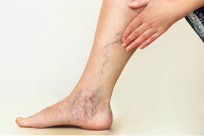 Varicose Veins with Laser Treatment in Baner