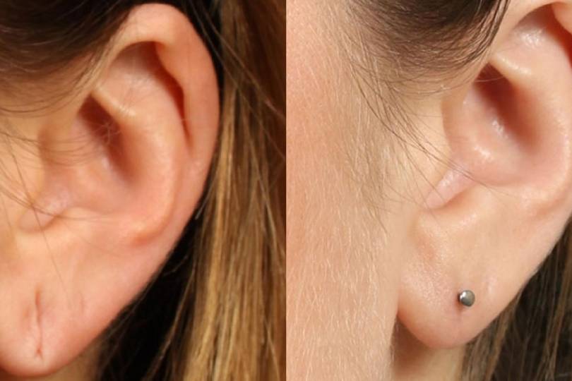 Ear Lobe repair in Baner