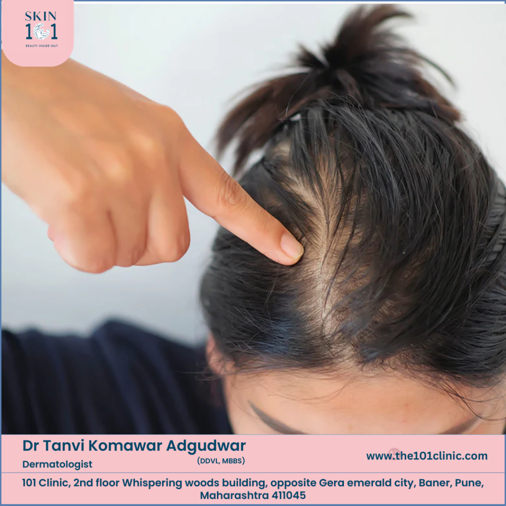 Thinning Hair in Women