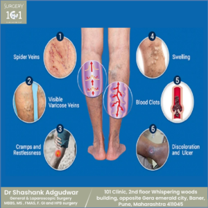 Varicose Vein Laser Surgery