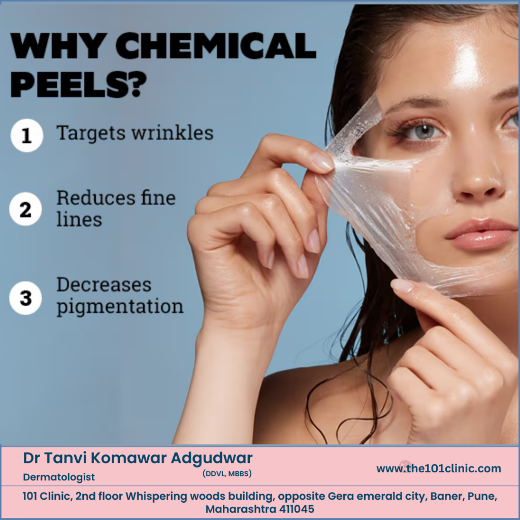 Chemical Peels Treatmenet at Home