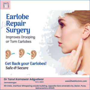Earlobe Repair Surgery in pune