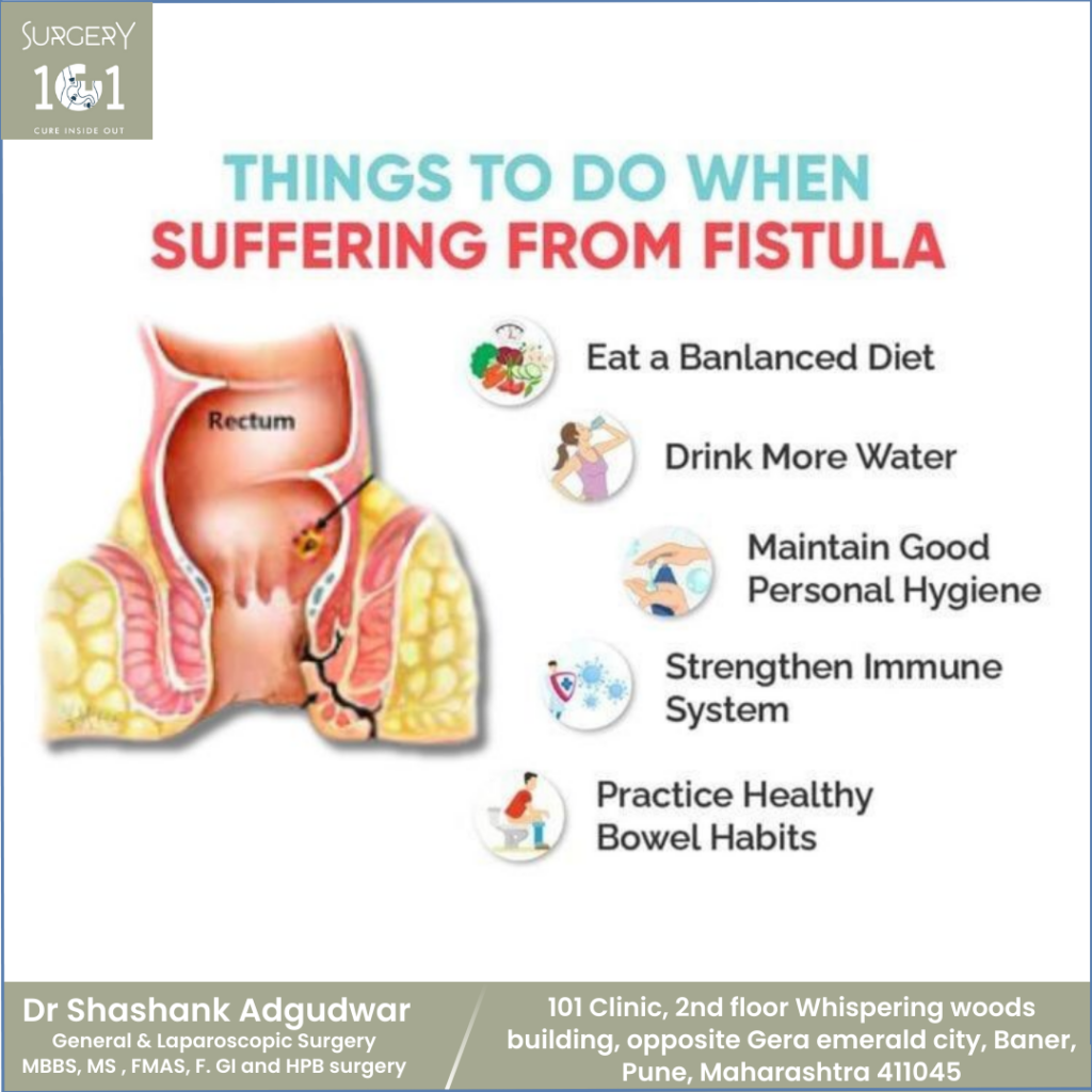 Fistula Treatment in baner