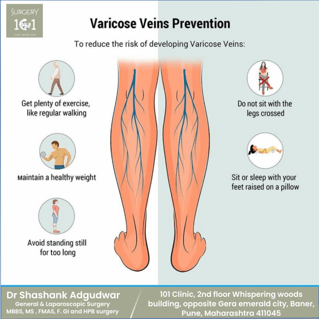 Varicose Veins Prevention: