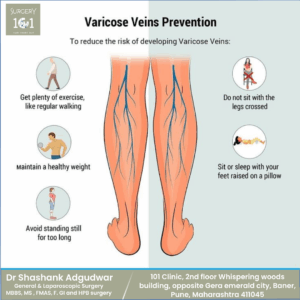 Varicose Veins Prevention: