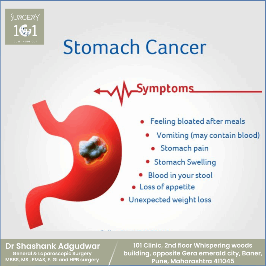 Stomach Cancer Treatment