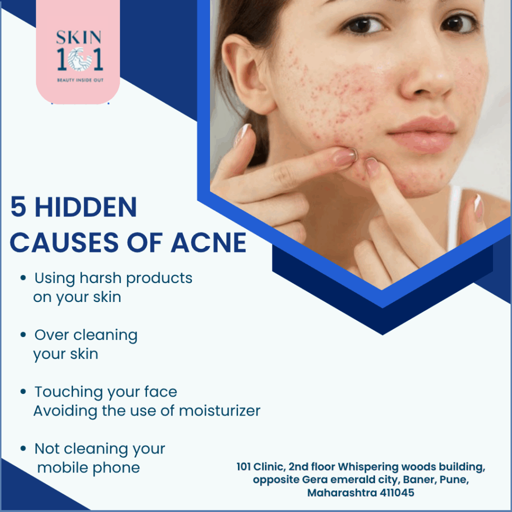 Acne Treatment in baner