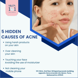 Acne Treatment in baner