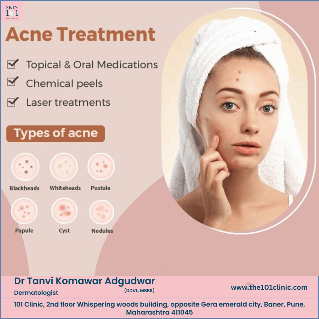 Acne Treatment in Baner