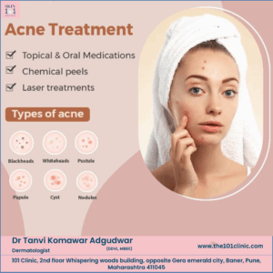 Acne Treatment in Baner