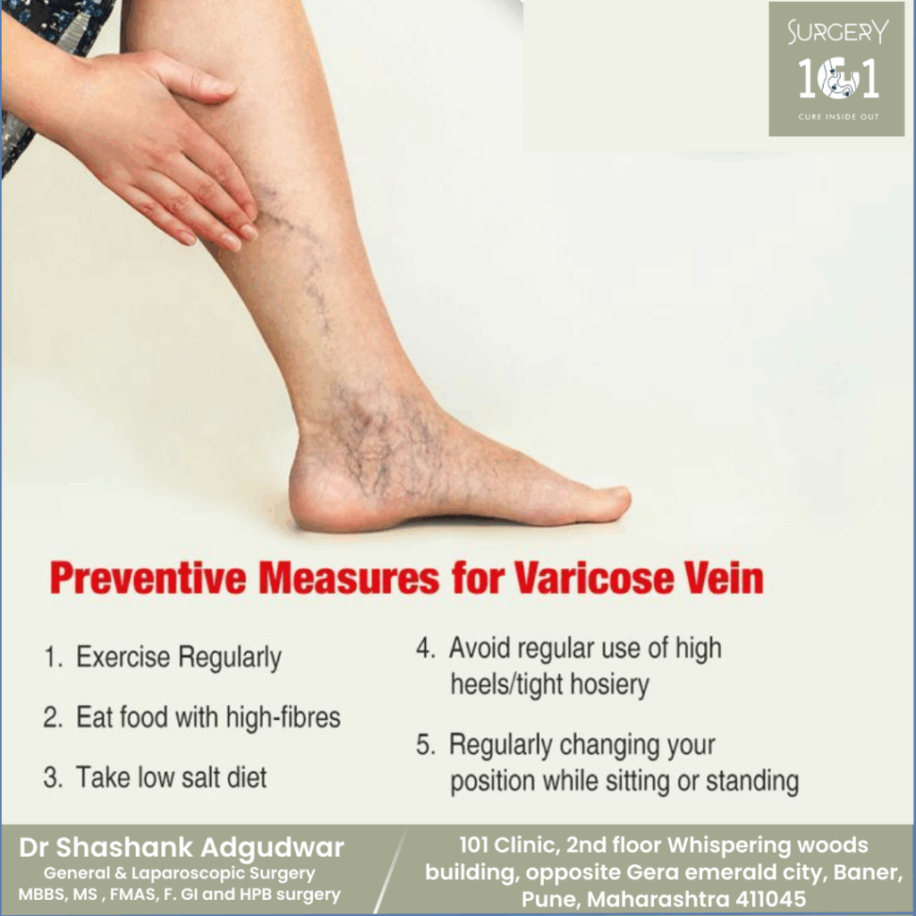 Preventing Varicose Veins