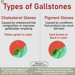 Types of Gallstones