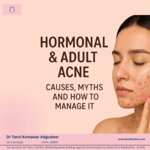 Hormonal & Adult Acne: